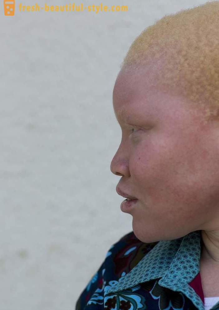 Tragická história tanzánskych albínov