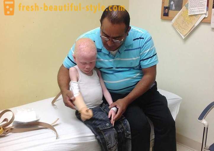 Tragická história tanzánskych albínov