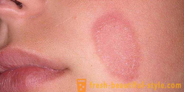 Šupinatá koža na tvári a rukách: Možné príčiny a charakteristiky starostlivosti