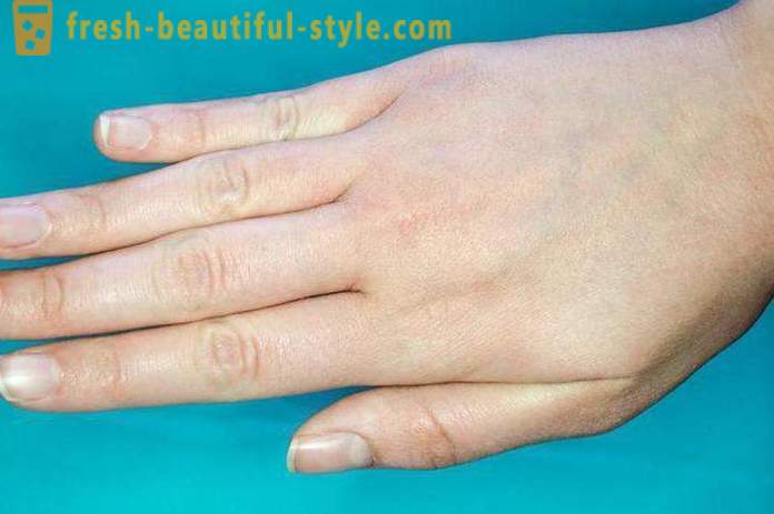 Šupinatá koža na tvári a rukách: Možné príčiny a charakteristiky starostlivosti