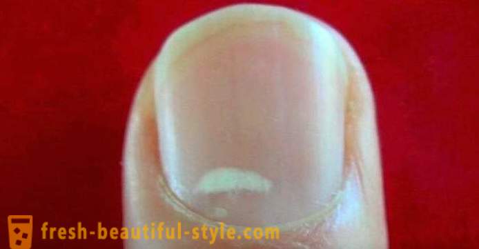 Biele škvrny na nechtoch prstov: príčiny a liečba