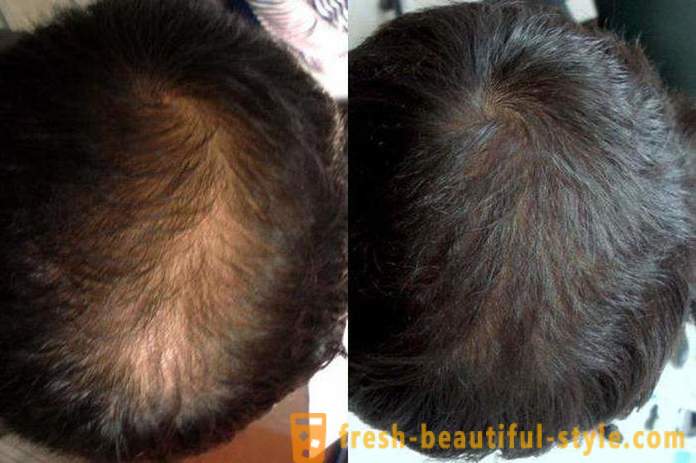 Lieky s minoxidil pre vlasy: recenzia, rysy a opis aplikácie toho najlepšieho
