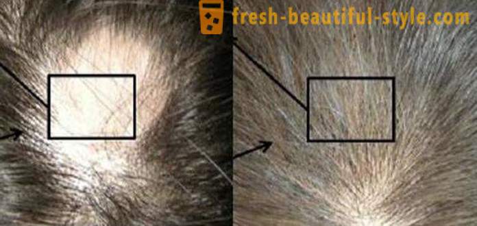 Mezoterapia na vlasy: Kozmetické nástroje a kontraindikácie