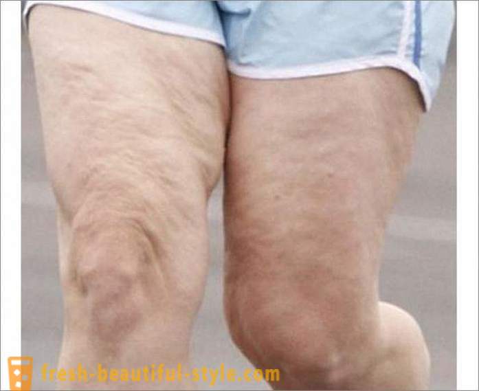 Ako sa zbaviť celulitídy na nohách? Cvičenie pre nohy celulitídy