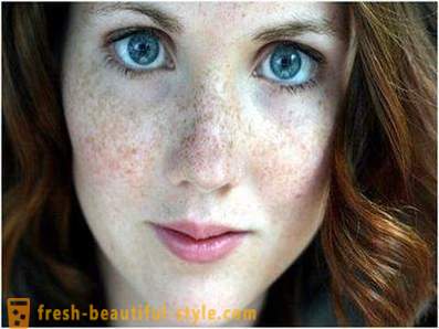 Postarať sa o ich krásu a mladosť: spôsobuje pigmentáciu v tvári